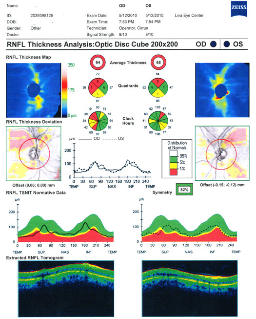 Retinal Nerve Fiber Layer